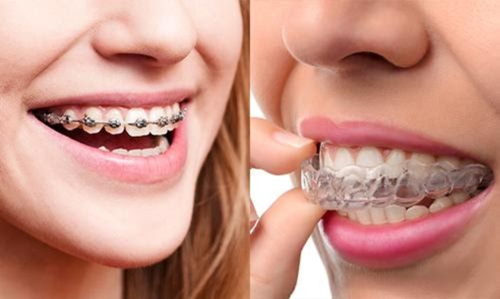 Invisible Aligners