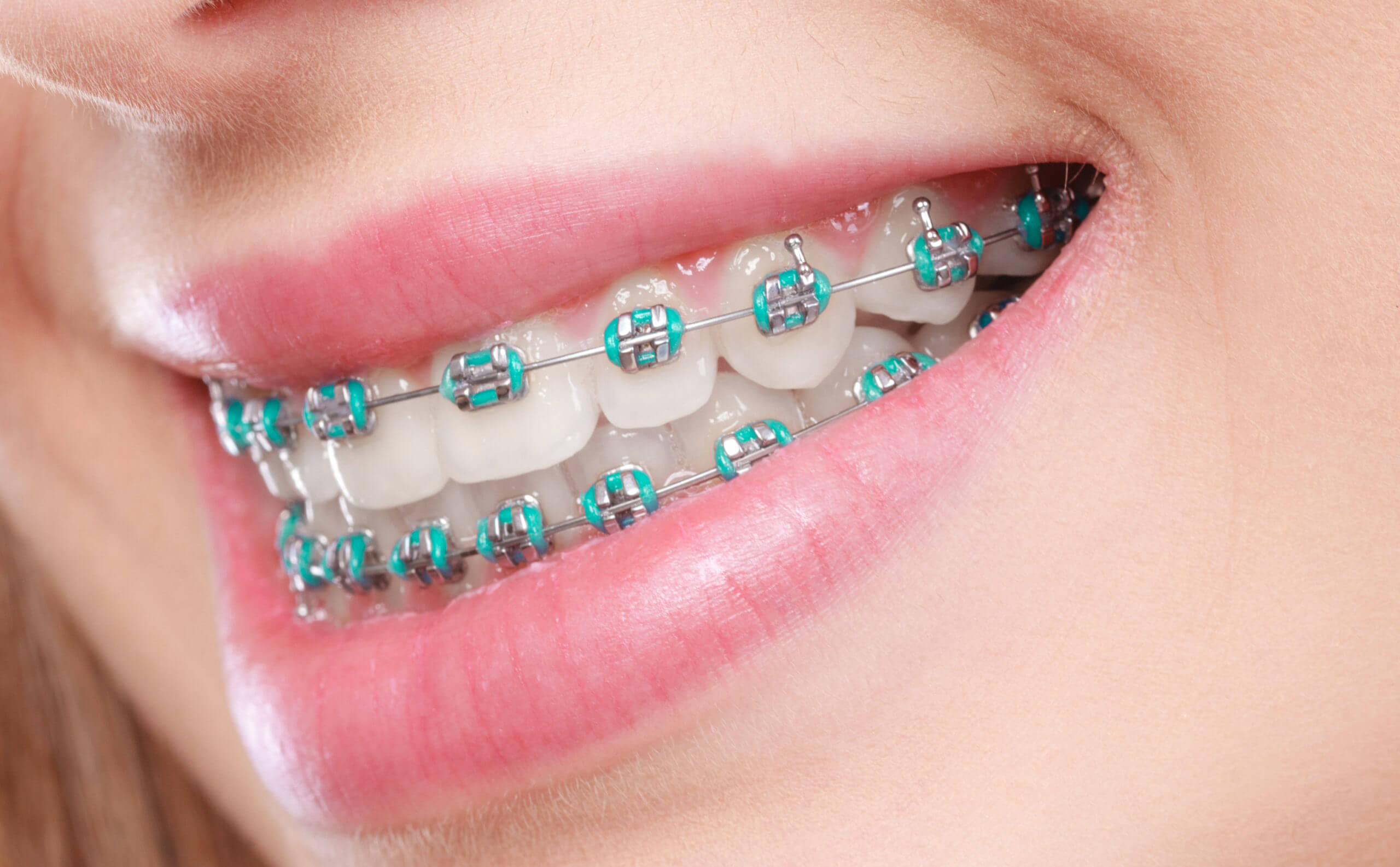 Orthodontics & Aligners