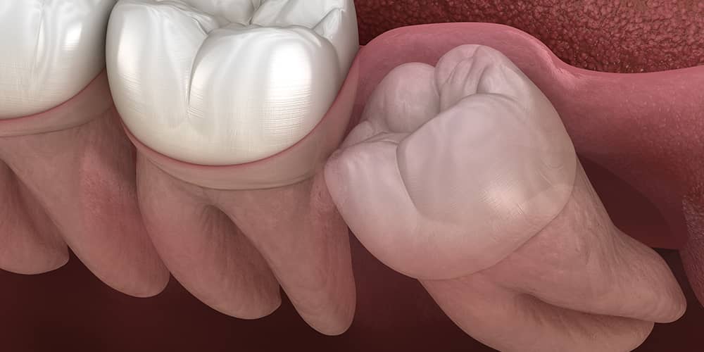 Wisdom Tooth Removal