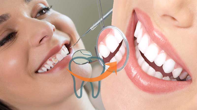 Smile Designing